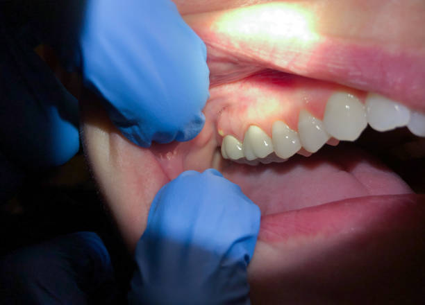 Best Chipped Tooth Repair Near Me  in Stevensville, MD